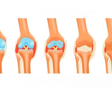 Rheumatoid Arthritis Stages Infographics