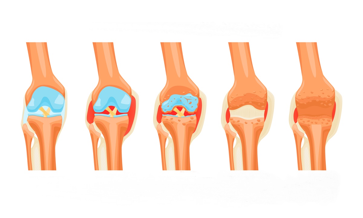 Rheumatoid Arthritis Stages Infographics